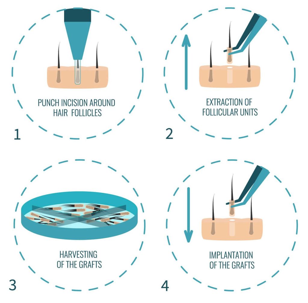 Robotic Hair Restoration 3 Sierra Robotic Hair Institute Robotic Hair Restoration 3 Sierra Robotic Hair Institute
