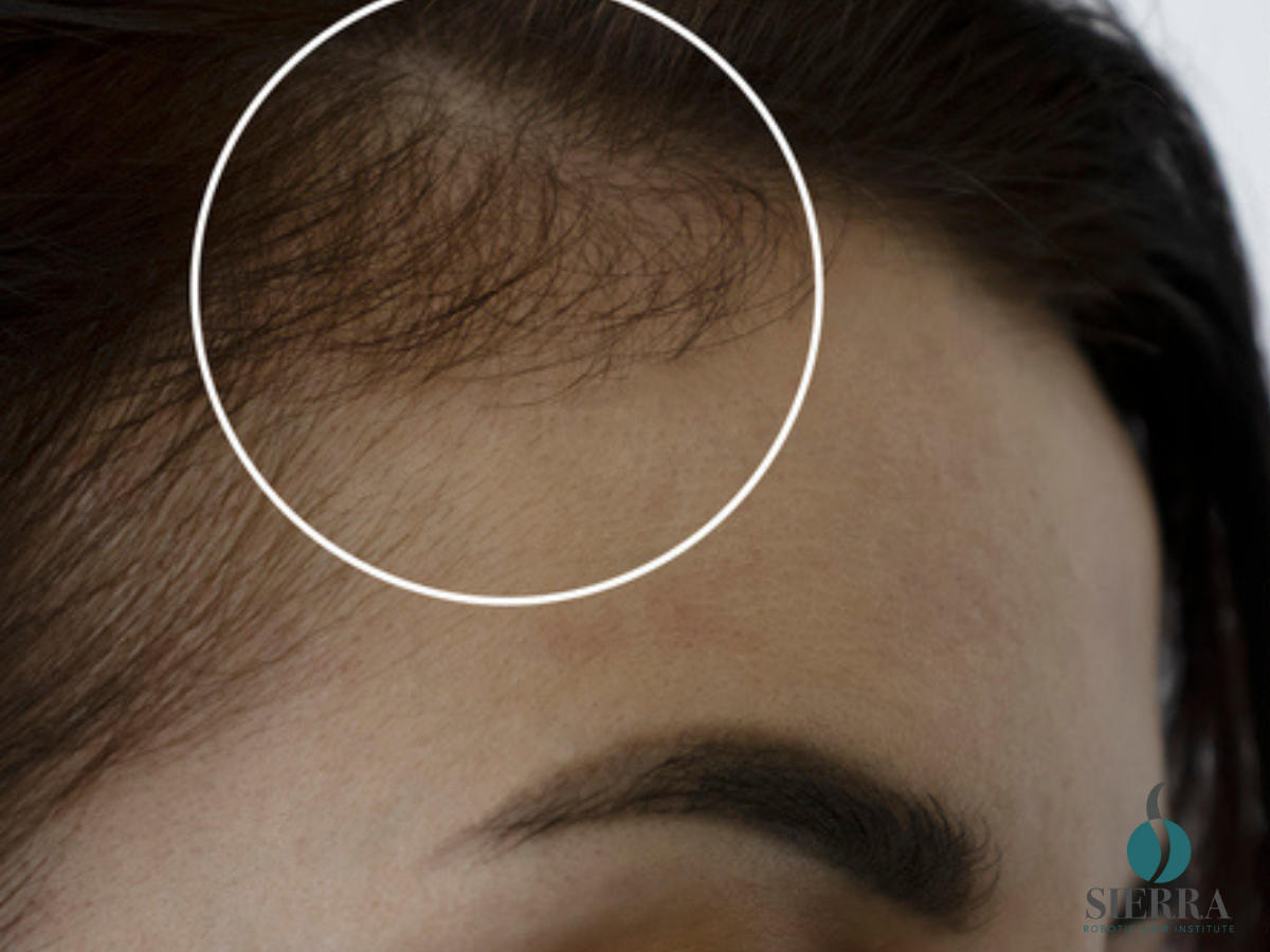 The Unique Advantages Of Women’s Hair Transplants With Sierra Robotic Hair Institute