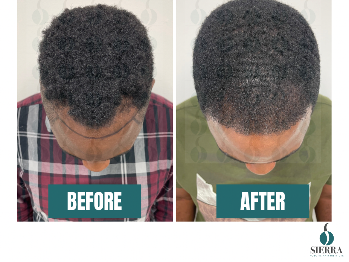 How Sierra Robotic Hair Institute Is Transforming Hair Restoration