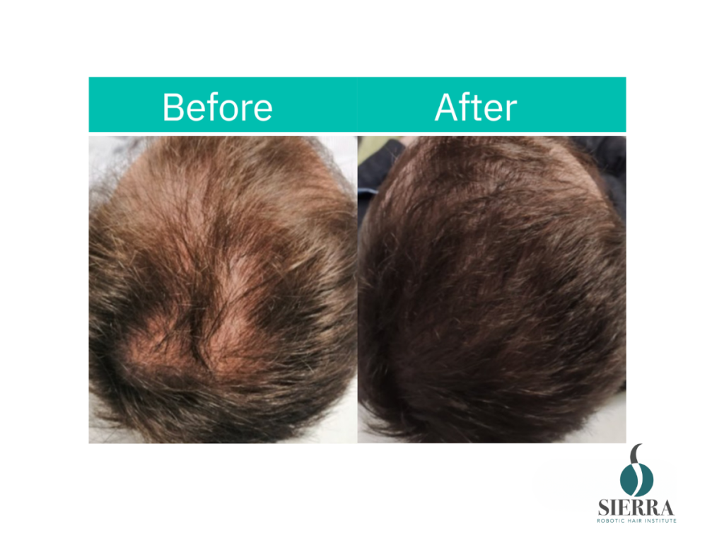 How Sierra Robotic Hair Institute Uses FDA-Cleared FoLix® Laser to Transform Hair Loss Treatment