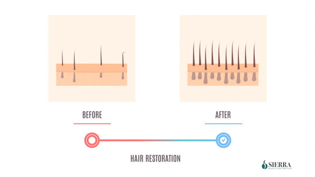 Benefits of Laser Hair Restoration Therapy
