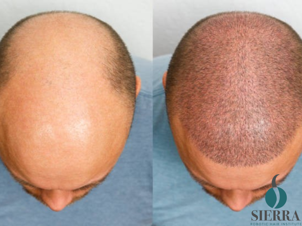 Scalp Micropigmentation Fort Lauderdale