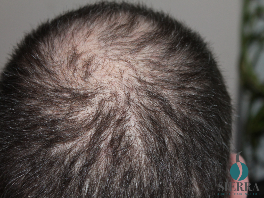 How the ARTAS iXi Robotic Hair Transplant Works