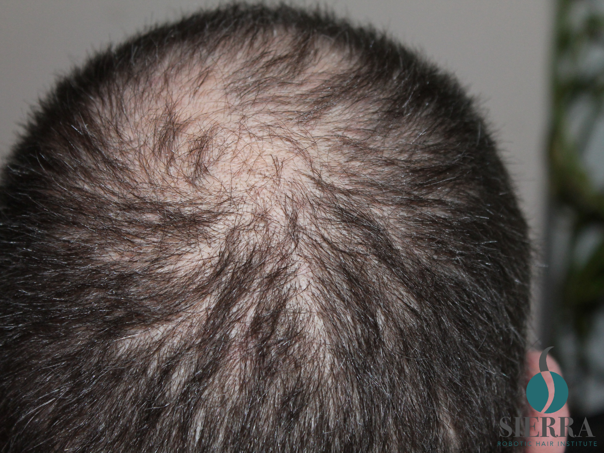 How the ARTAS iXi Robotic Hair Transplant Works